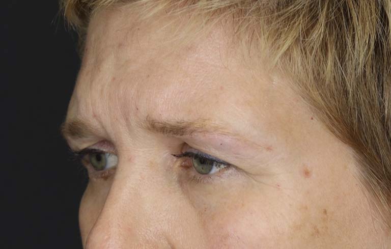 Blepharoplasty case #2634