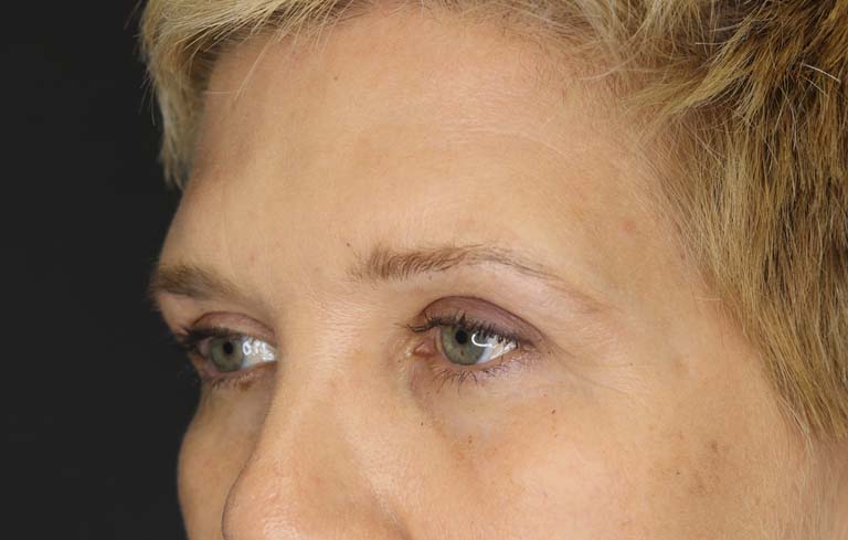 Blepharoplasty case #2634