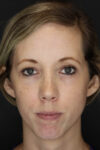 Facial Filler case #3625