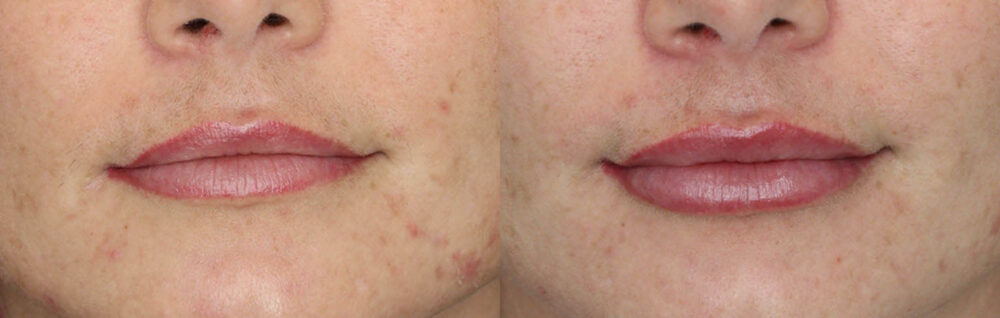 Lip Filler case #3796