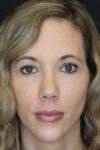 Facial Filler case #3625