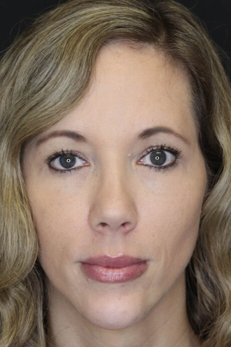 Facial Filler case #3625
