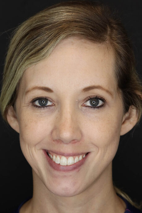 Facial Filler case #3625