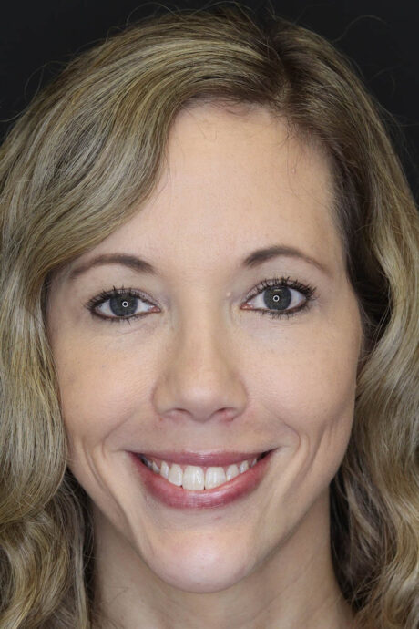 Facial Filler case #3625