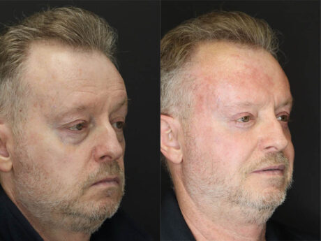 Fat Grafting case #3567