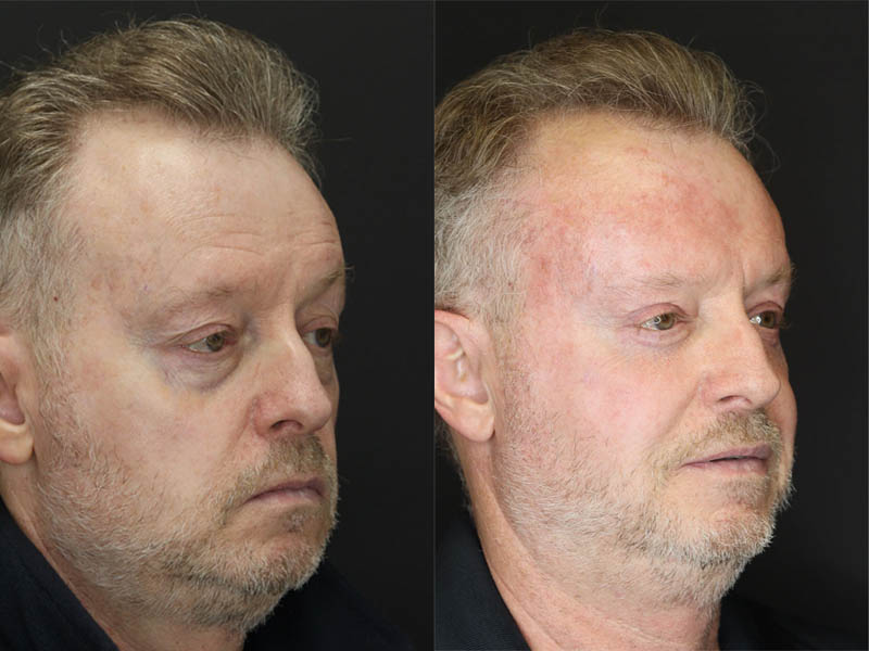 Fat Grafting case #3567