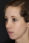 Facial Filler case #3625