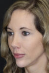 Facial Filler case #3625