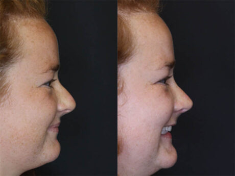 Rhinoplasty case #3451