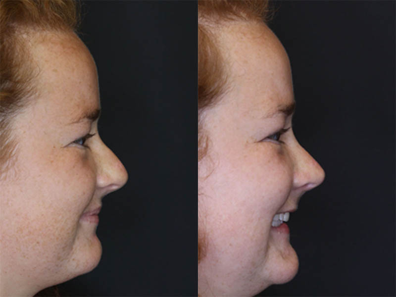 Rhinoplasty case #3451