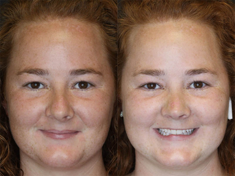 Rhinoplasty case #3451