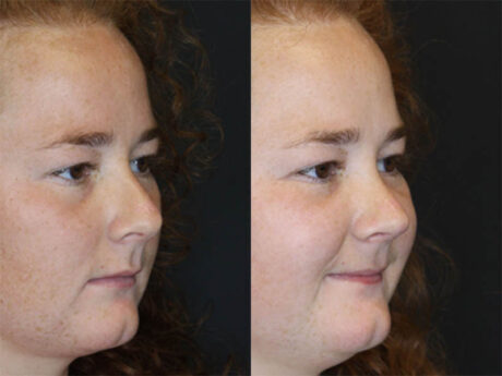 Rhinoplasty case #3451
