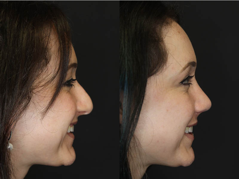 Rhinoplasty case #3461