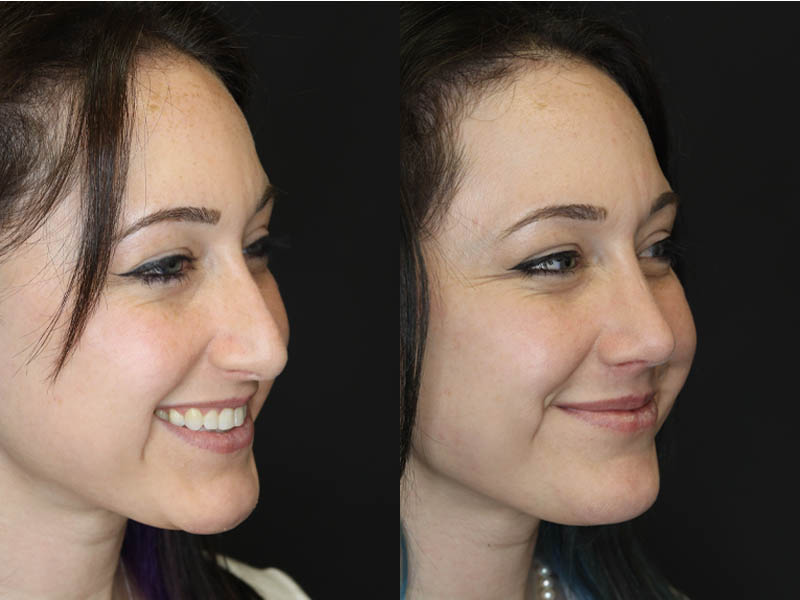 Rhinoplasty case #3461