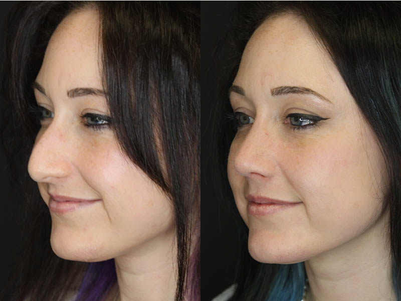 Rhinoplasty case #3461