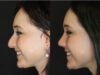 Rhinoplasty case #3461 slider thumbnail