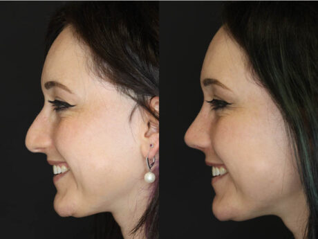Rhinoplasty case #3461