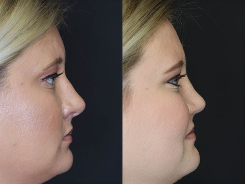 Rhinoplasty case #3475