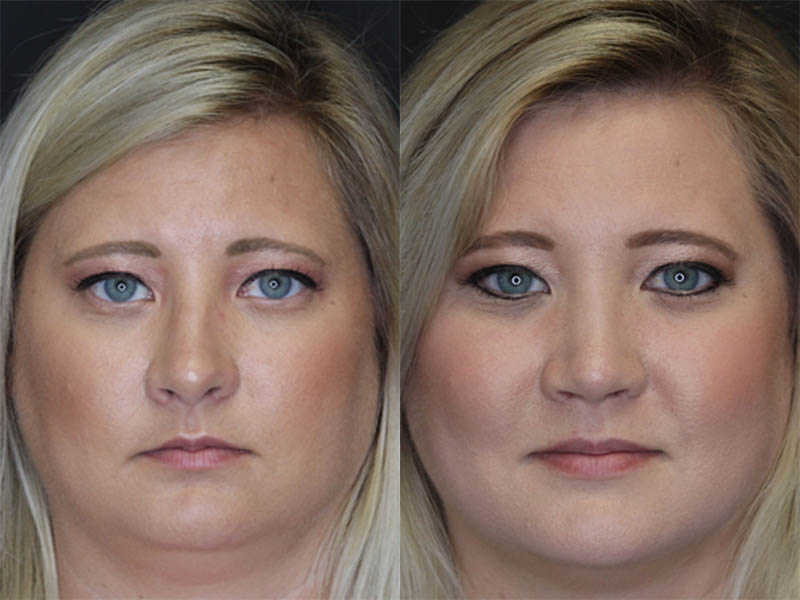 Rhinoplasty case #3475