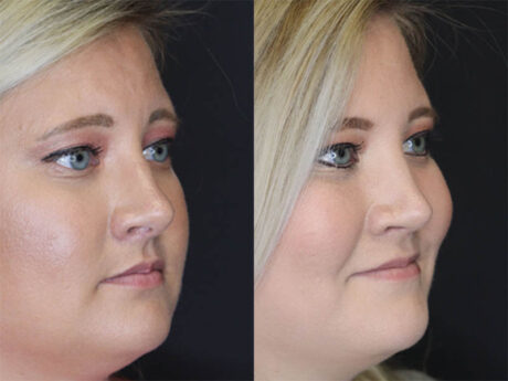 Rhinoplasty case #3475