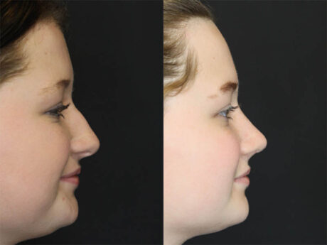 Rhinoplasty case #3482