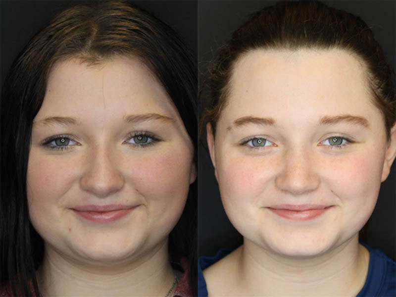Rhinoplasty case #3482