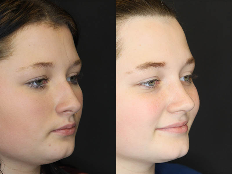 Rhinoplasty case #3482