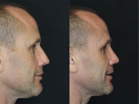 Rhinoplasty case #3489