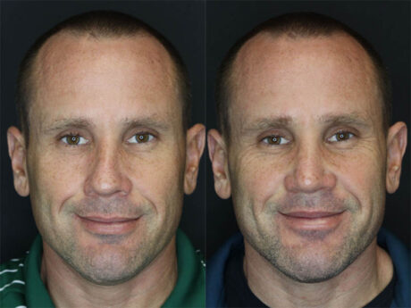 Rhinoplasty case #3489