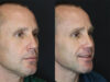 Rhinoplasty case #3489 slider thumbnail