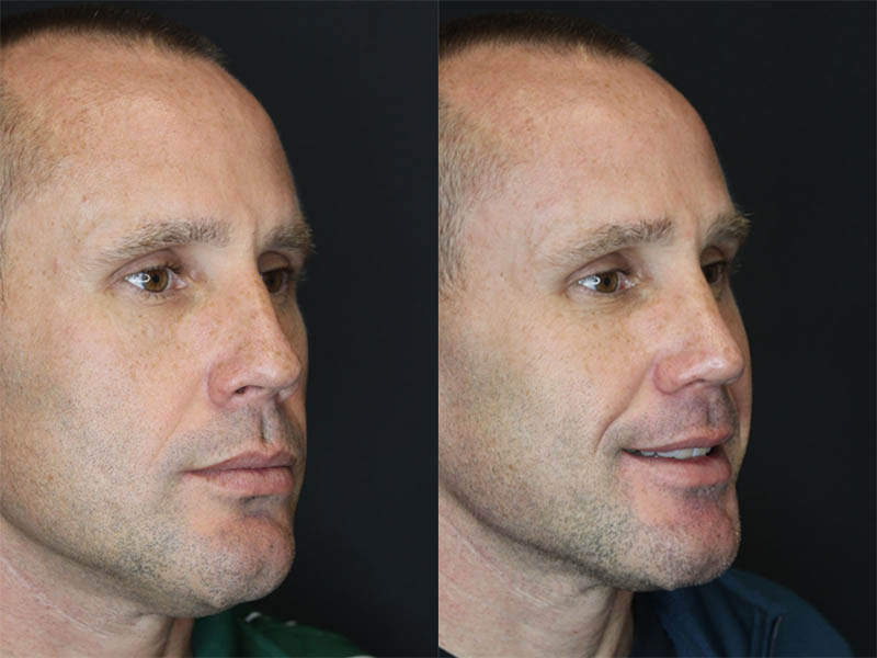Rhinoplasty case #3489
