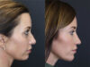 Facial Filler case #3760 slider thumbnail