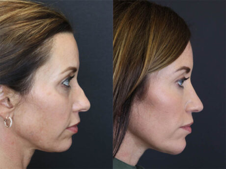 Facial Filler case #3760