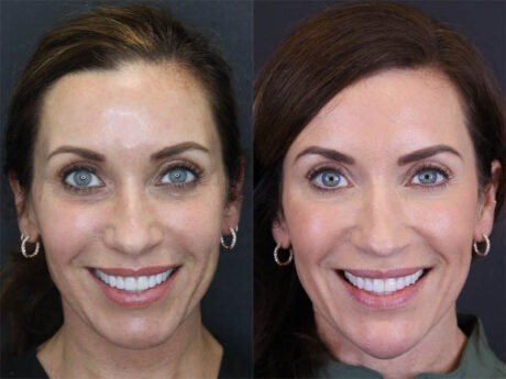 Facial Filler case #3760