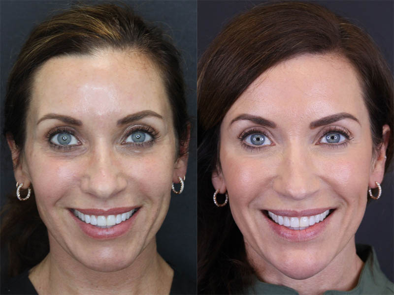 Facial Filler case #3760