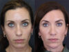 Facial Filler case #3760 slider thumbnail