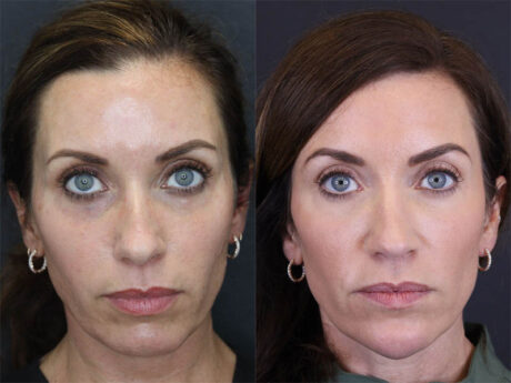 Facial Filler case #3760