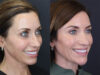 Facial Filler case #3760 slider thumbnail