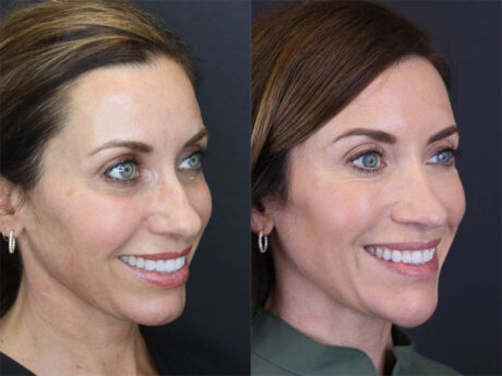 Facial Filler case #3760
