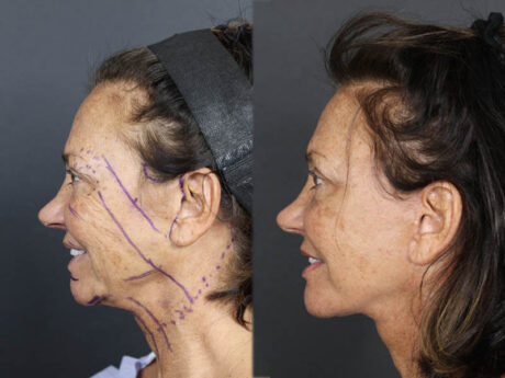 Facelift case #3515
