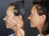 Facelift case #3515 slider thumbnail