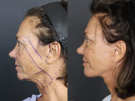 Facelift case #3515