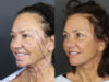 Facelift case #3515 slider thumbnail