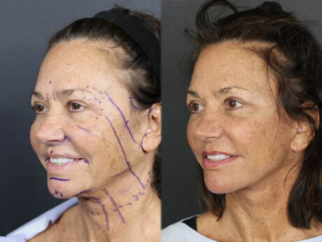 Facelift case #3515