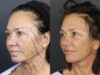 Facelift case #3515 slider thumbnail