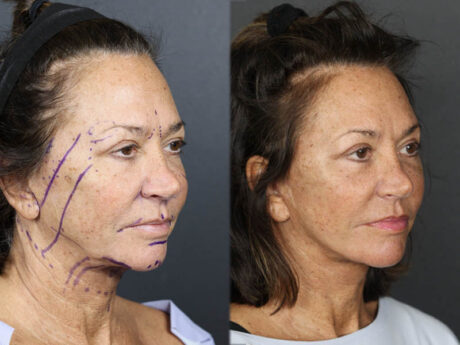 Facelift case #3515