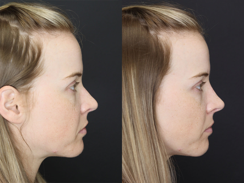 Liquid Rhinoplasty case #3589