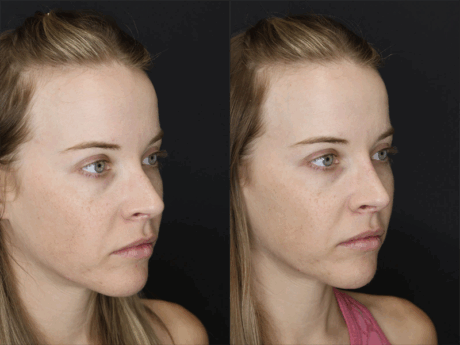 Liquid Rhinoplasty case #3589