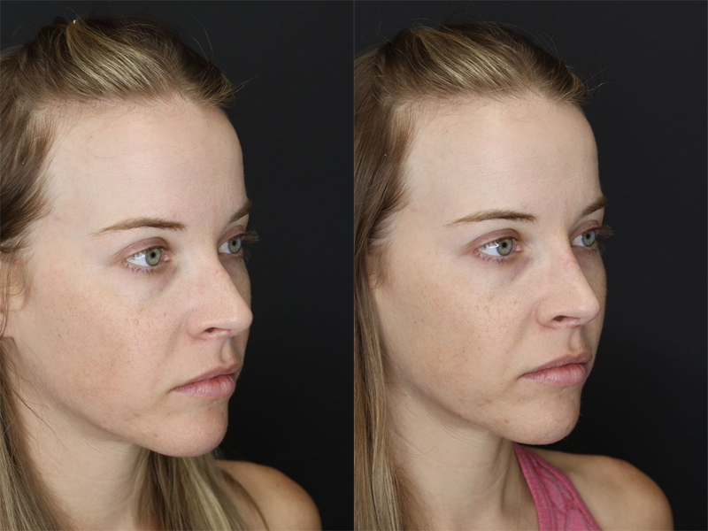 Liquid Rhinoplasty case #3589