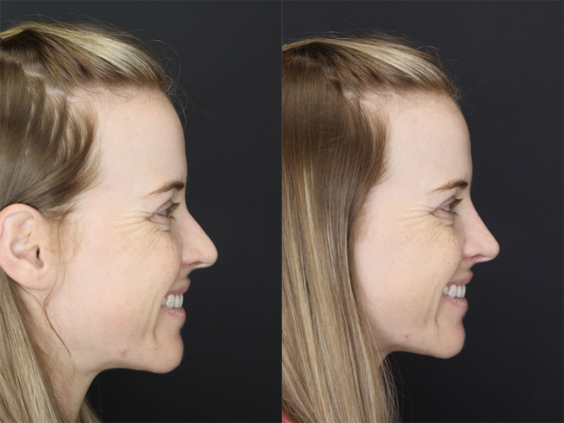 Liquid Rhinoplasty case #3589